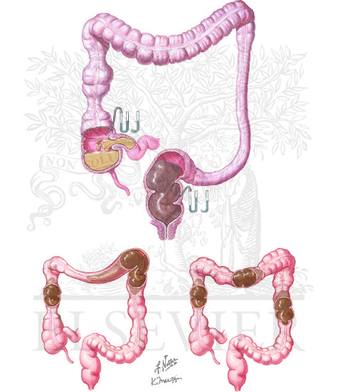 Watermarked preview of unlabeled image: Motility of the Large Intestine