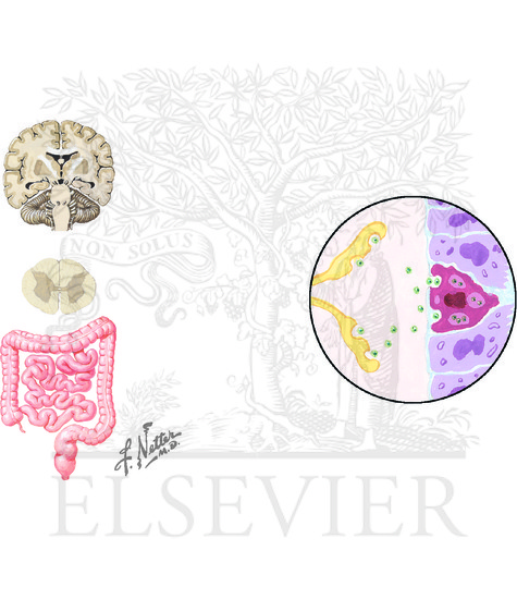 Watermarked preview of unlabeled image: Irritable Bowel Syndrome, Constipation Predominant