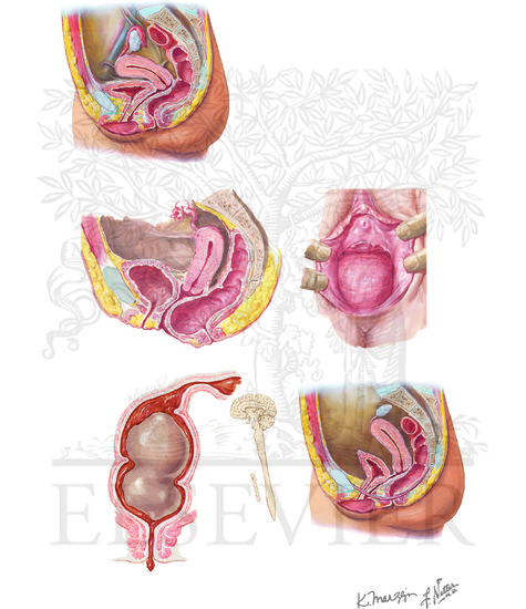 Pelvic Floor Dysfunction And Constipation