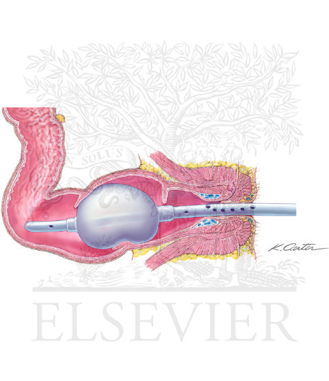 Watermarked preview of unlabeled image: Fecal Incontinence 