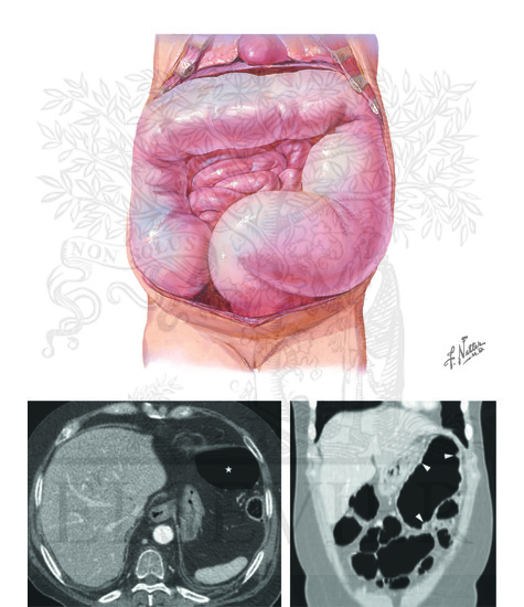 Chronic Colonic Pseudoobstruction and Toxic Megacolon: Toxic Megacolon