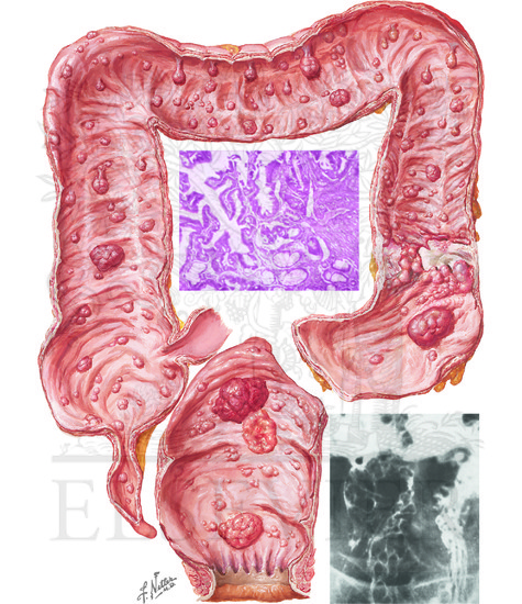 Polyposis Syndromes: Familial Polyposis