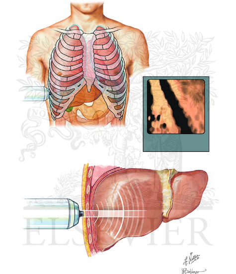 Watermarked preview of unlabeled image: Noninvasive Assessments for Hepatic Fibrosis