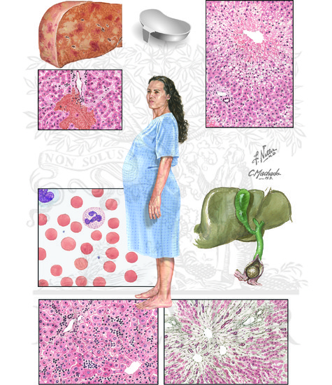 Watermarked preview of unlabeled image: Liver Disease in Pregnancy: Liver Diseases Caused by Pregnancy and Incidental to Pregnancy 