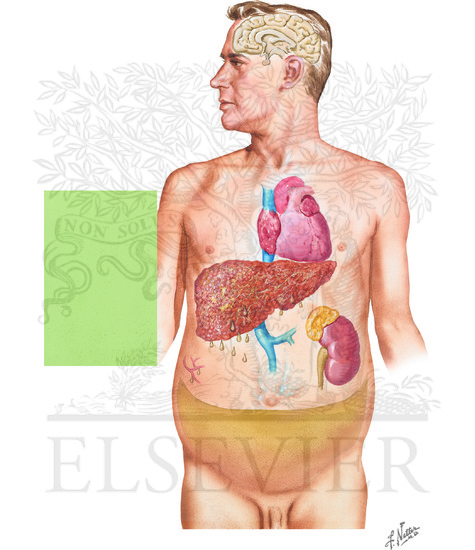 Watermarked preview of unlabeled image: Ascites: Pathogenesis