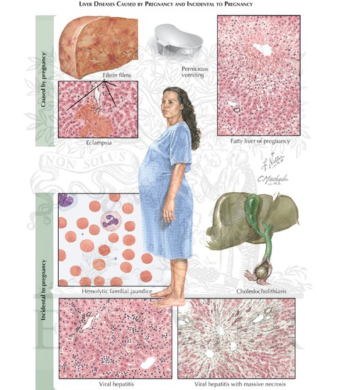 Liver Disease in Pregnancy: Liver Diseases Caused by Pregnancy and Incidental to Pregnancy 