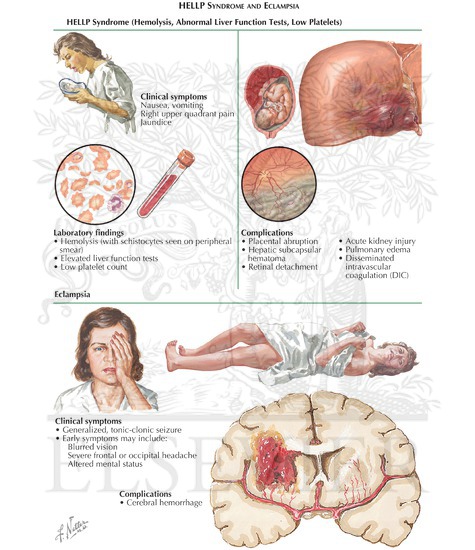 Liver Disease in Pregnancy (Continued): HELLP Syndrome and Eclampsia