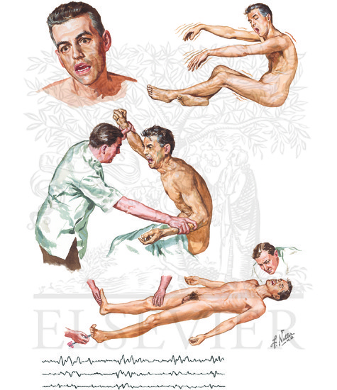 Hepatic Encephalopathy