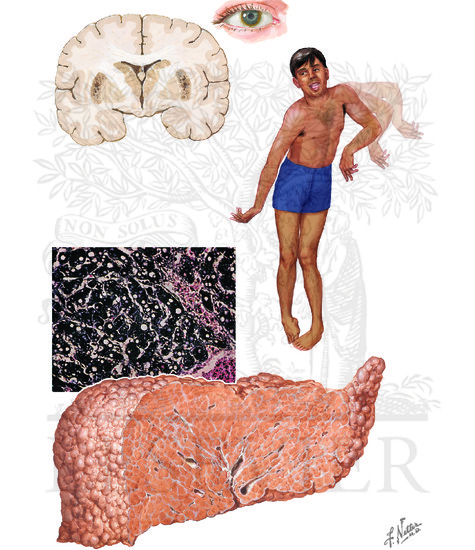 Wilson Disease