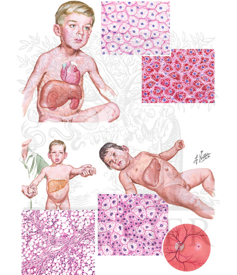 Watermarked preview of unlabeled image: Other Inherited Metabolic Disorders (von Gierke's Disease, Galactosemia, Nieman-Pick's Disease)