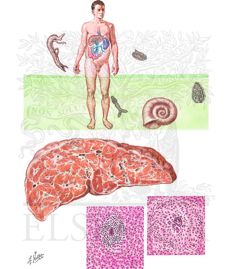 Watermarked preview of unlabeled image: Schistosomiasis
