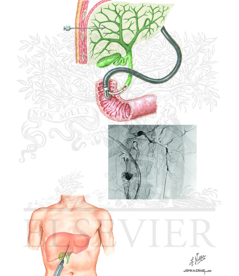 Percutaneous Transhepatic Cholangiography and Endoscopic retrograde ...