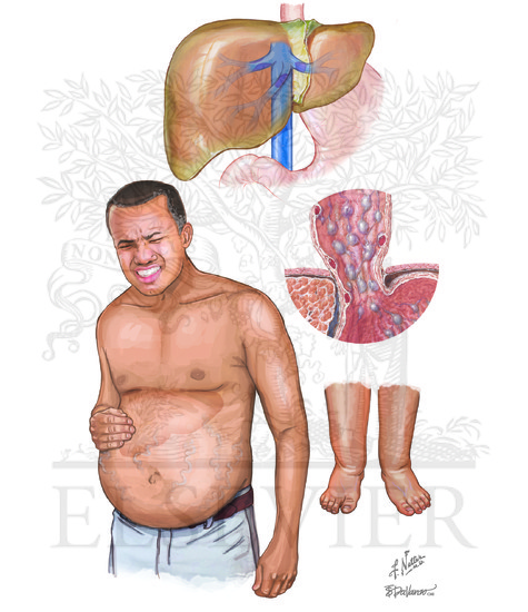 Watermarked preview of unlabeled image: Hepatic Vein Obstruction: Budd Chiari Syndrome