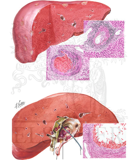Vascular Disturbances:  Periarteritis Nodosa, Aneurysm
