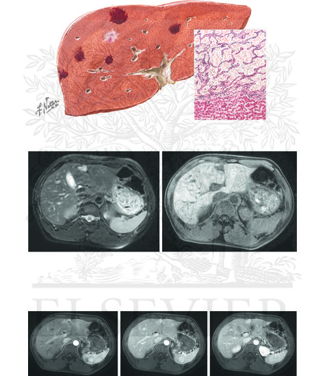 Benign Liver Tumors: Hemangioma