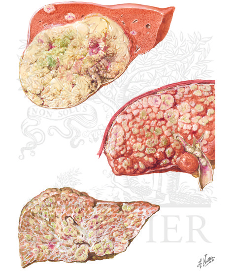 Hepatocellular Carcinoma: Gross Features