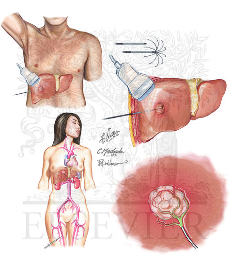 Watermarked preview of unlabeled image: Nonsurgical Therapies for Localized Hepatocellular Carcinoma: Percutaneous ablation, transarterial embolization and radiotherapy