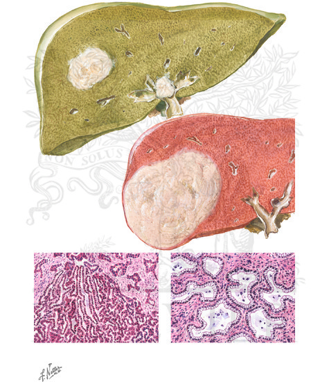 Watermarked preview of unlabeled image: Cholangiocarcinoma