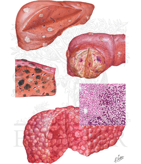 Watermarked preview of unlabeled image: Metastatic Liver Cancer