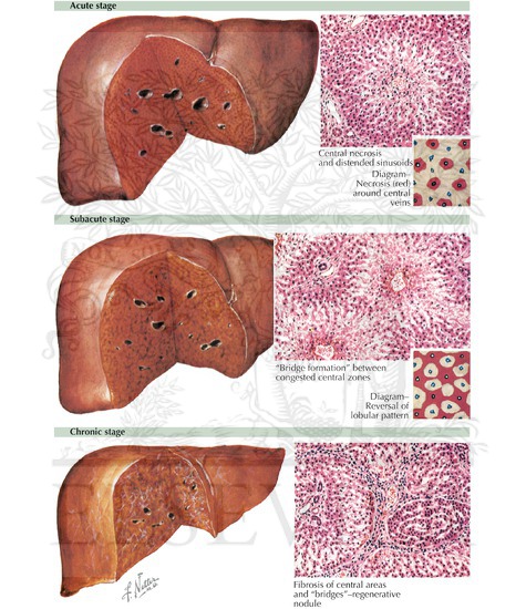 Cardiac Liver (Congestive Hepatopathy)