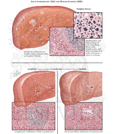 Hematologic Malignancy and the Liver: Hodgkin’s Disease, Leukemia, Venoocclusive disease, graft vs host disease: Acute lymphoblastic (ALL) and myeloid leukemia (AML)