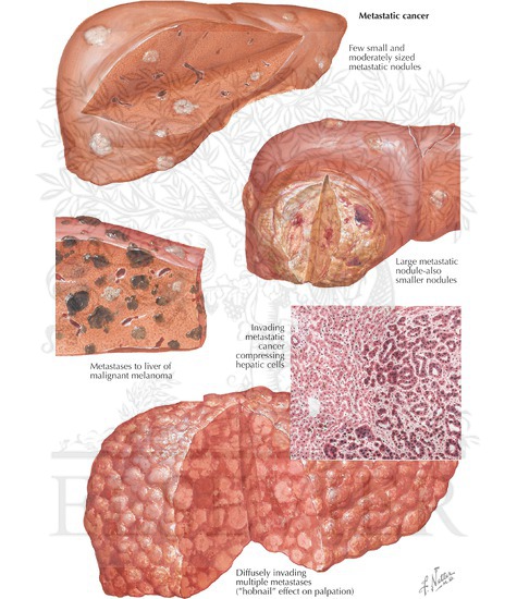 cancer metastatic in liver)