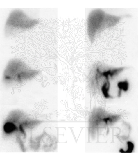 Watermarked preview of unlabeled image: Function of Gallbladder and Choledochoduodenal Sphincter (Continued): HIDA Scan