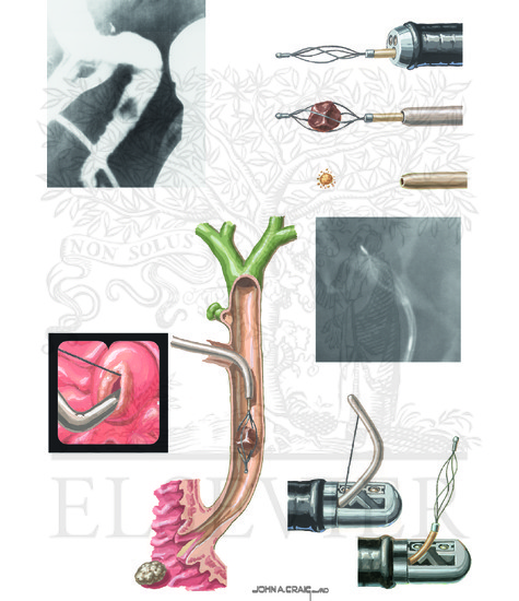Invasive Imaging Modalities and Minimally Invasive Interventions of the Bile Duct (Continued): Choledocholithiasis and Cholangitis: Management of Stones