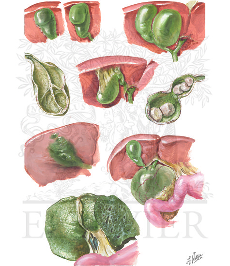 Congenital Anomalies: Gallbladder and Bile Ducts