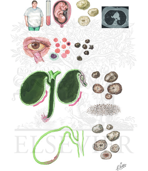 Watermarked preview of unlabeled image: Cholelithiasis: Stone Formation