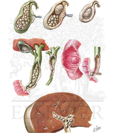 Cholelithiasis: Pathologic Features, Choledocholithiasis