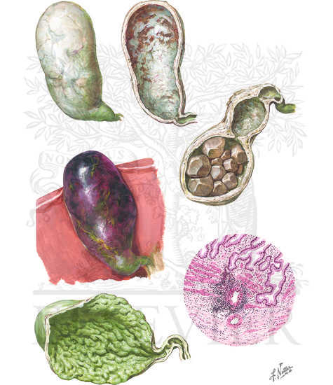 Cholecystitis: Later Stages and Complications