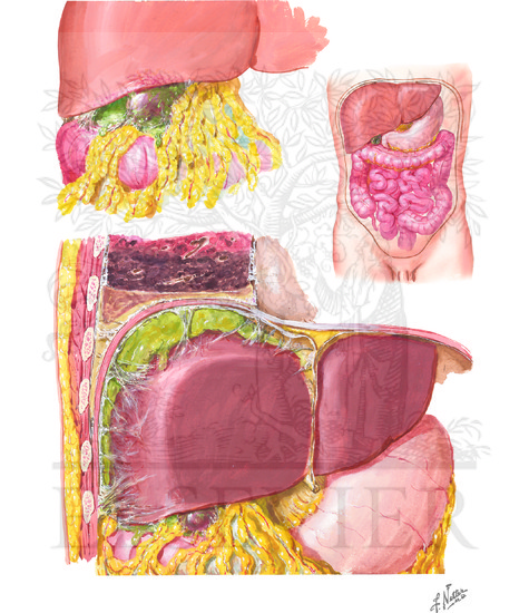 Watermarked preview of unlabeled image: Perforation, Subphrenic Abscess