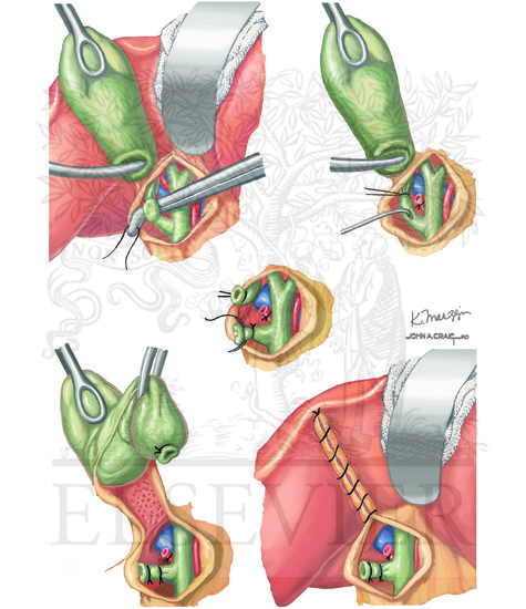 Watermarked preview of unlabeled image: Biliary injuries and Cholangitis (Continued): Open Cholecystectomy