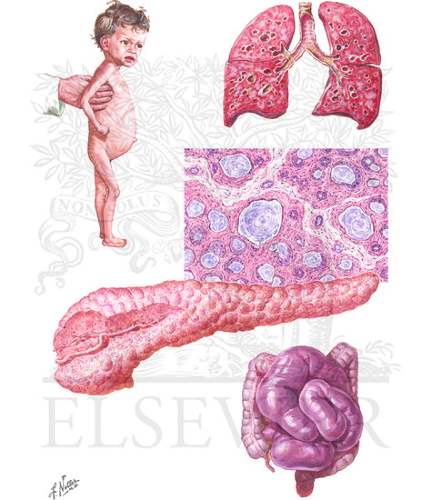 Cystic Fibrosis of Pancreas 