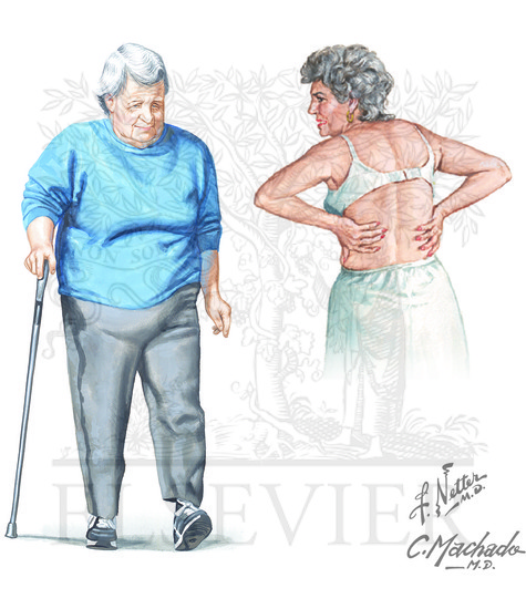 Fatigue and dyspnea on exertion with decreased exercise tolerance are common complaints