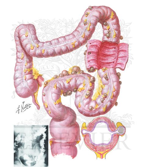 Watermarked preview of unlabeled image: Diverticular Disease