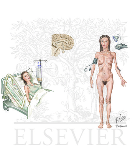 Anorexia Nervosa