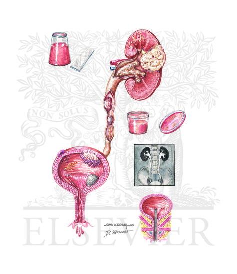 Watermarked preview of unlabeled image: Causes and Evaluaton of Hematuria