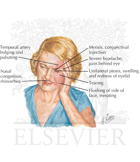 Cluster Headache