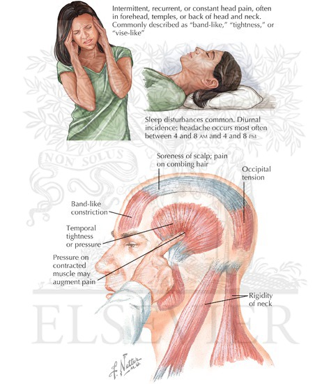 Muscle Contraction Headache