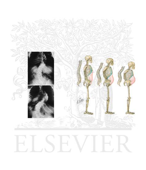 Watermarked preview of unlabeled image: Progression of Scoliotic Curve in Adult