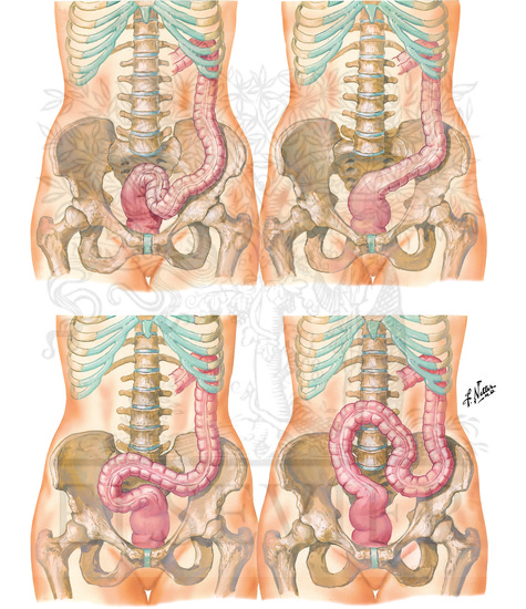 Watermarked preview of unlabeled image: Sigmoid Colon:  Variations in Position