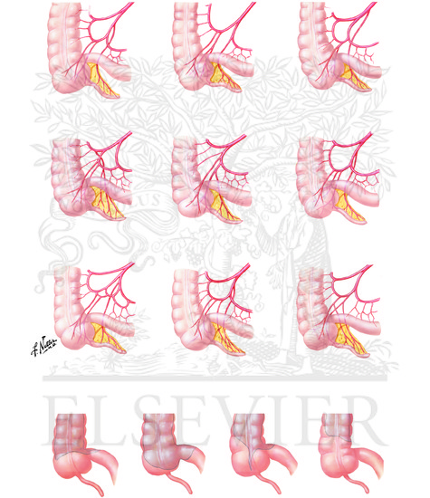 Variations in Arterial Supply to Cecum and Posterior Peritoneal Attachment of Cecum