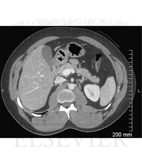 Axial CT Image of Upper Abdomen