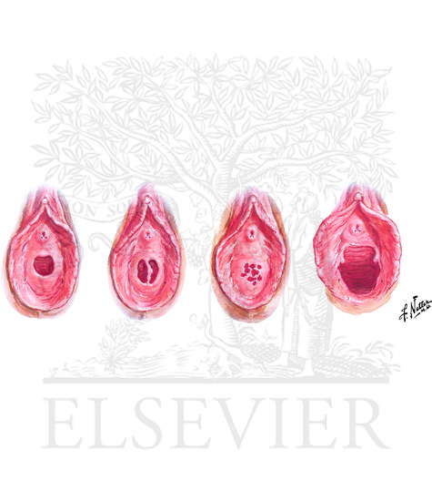 Variations in Hymen