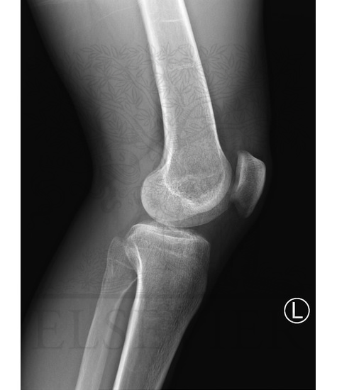 Watermarked preview of unlabeled image: Knee Radiograph: Lateral View