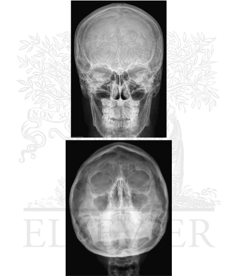 Watermarked preview of unlabeled image: Skull: Radiographs