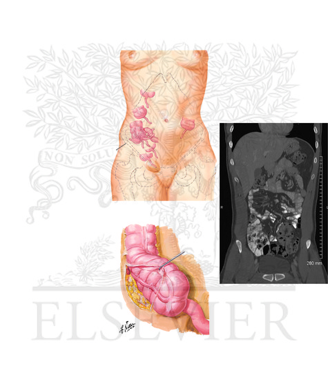 (Vermiform) Appendix