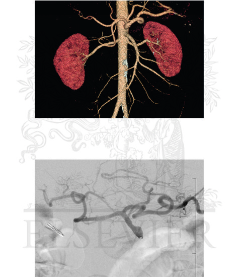 Watermarked preview of unlabeled image: Celiac Arteriogram and CT Angiogram